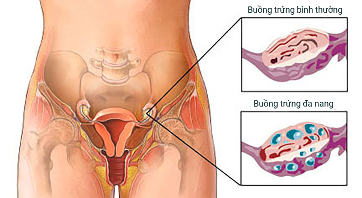 Buồng trứng đa năng - Nguyên nhân, triệu chứng và cách điều trị