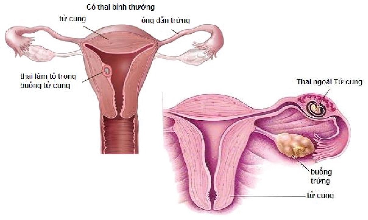 Nguyên nhân gây tắc vòi trứng